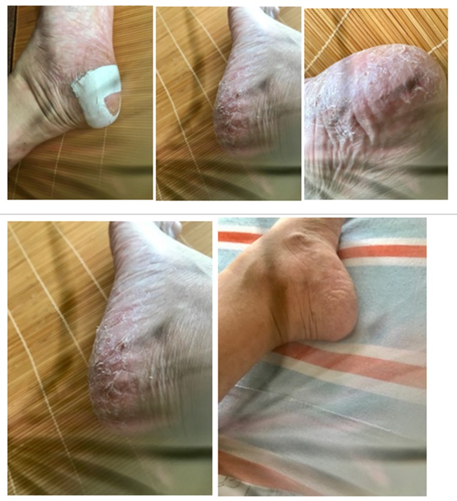 Foot Condition Recovery